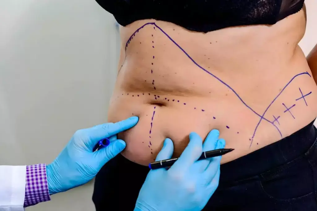 Can You Get Liposuction If You're Overweight or Obese? 2 Can You Get Liposuction If You're Overweight or Obese?