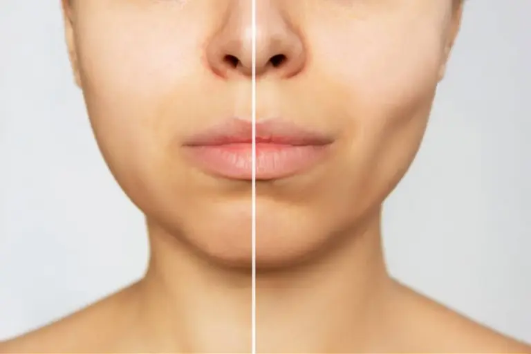 How to Remove Cheekbone Fat: Complete Guide