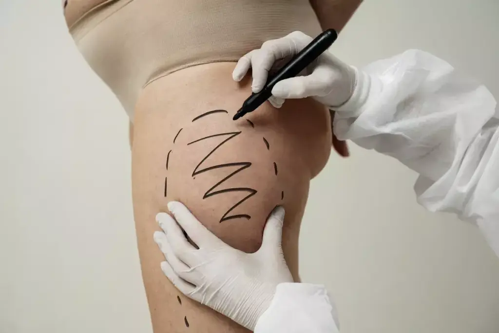 How to Get Knee Liposuction: Complete Guide