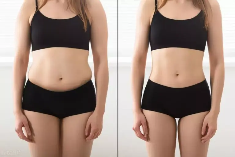 How to Get Thigh Liposuction: Before and After Results