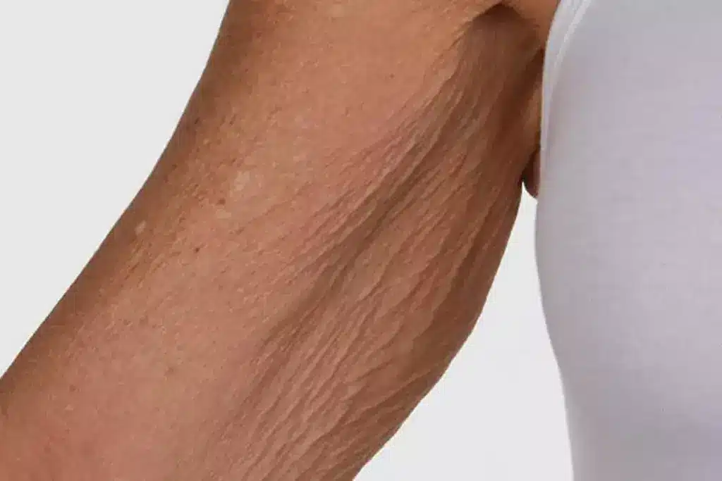 How to Fix Crepey Skin on Legs: Complete Guide 2 How to Fix Crepey Skin on Legs: Complete Guide