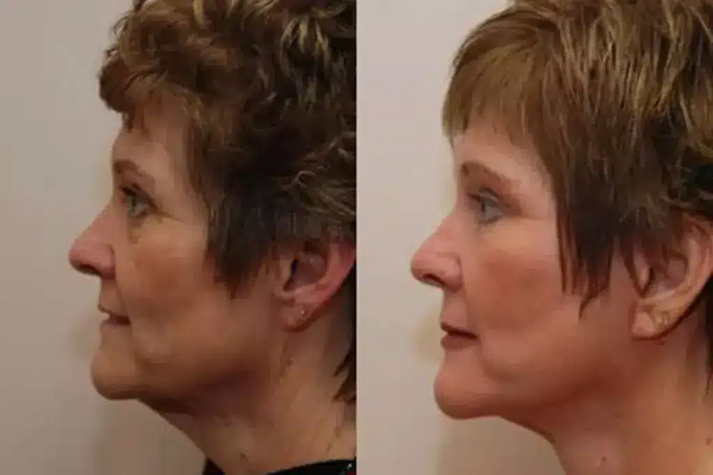 What's the Difference Between a Mini Facelift and Full Facelift? 2 image 2004 LIV Hospital