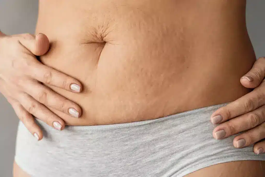 Does a Tummy Tuck Remove Stretch Marks?