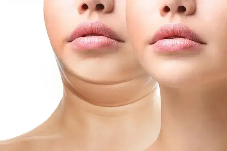 How to Remove Double Chin with Cryotherapy: Before & After Results