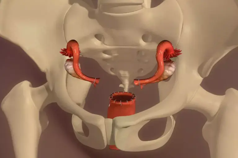 How to Perform a Transvaginal Hysterectomy: Steps