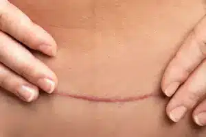 How to Identify Torn Internal Stitches After Hysterectomy