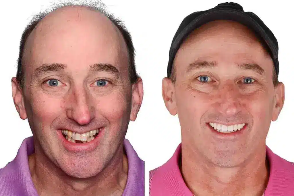 How to Choose the Best Cheek Implants for You 1 How to Choose the Best Cheek Implants for You