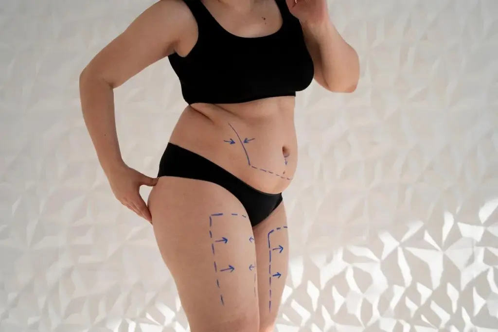 What Is HD Lipo and How Does It Compare to Traditional Liposuction? 1 What Is HD Lipo and How Does It Compare to Traditional Liposuction?