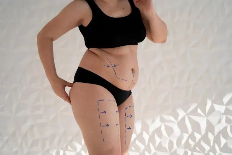 What Is HD Lipo and How Does It Compare to Traditional Liposuction?