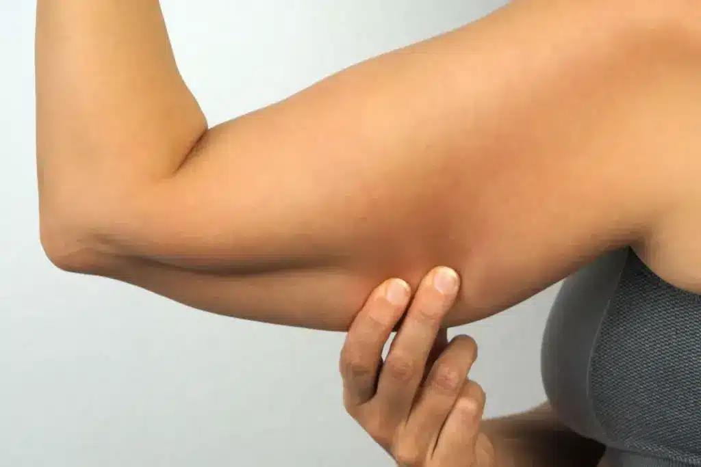 How to Reduce Arm Fat with Injections: A Complete Guide 1 How to Reduce Arm Fat with Injections: A Complete Guide