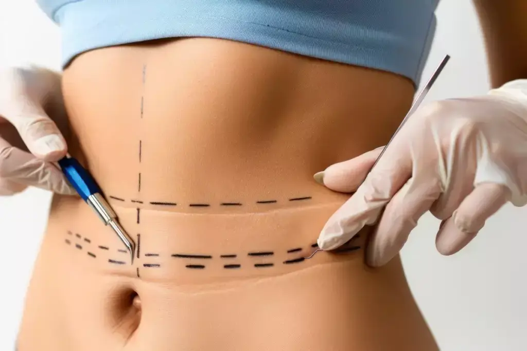 What Is HD Lipo and How Does It Compare to Traditional Liposuction? 3 What Is HD Lipo and How Does It Compare to Traditional Liposuction?