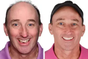 How to Choose the Best Cheek Implants for You