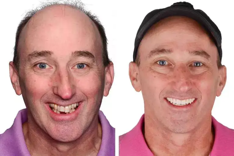 How to Choose the Best Cheek Implants for You