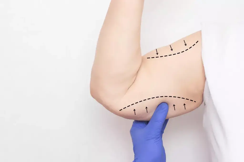 Is Arm Liposuction Dangerous? Safety Risks and Complications Explained