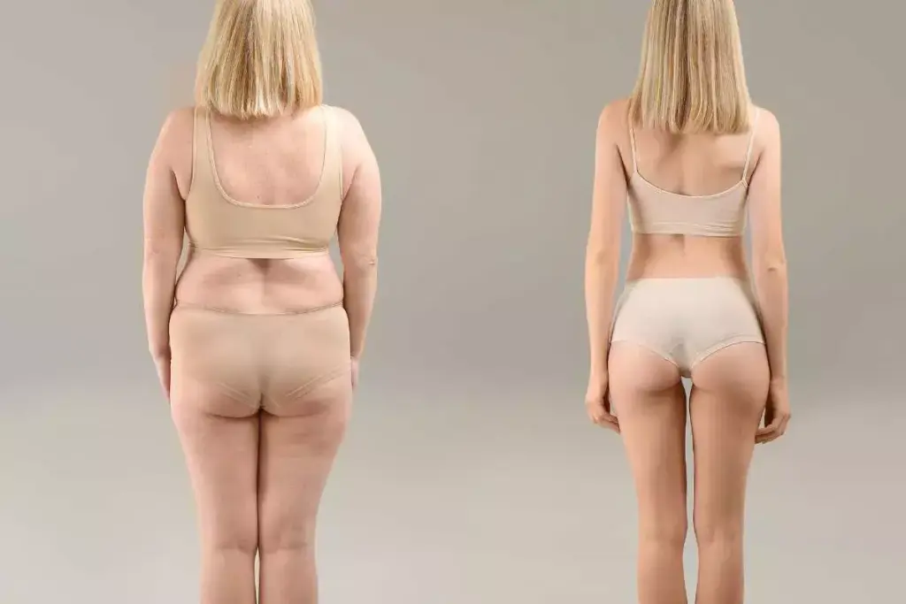 How to Get Full Back Liposuction Results: Before and After