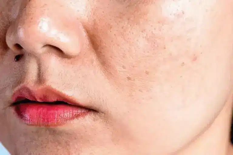 How to Remove Loose Skin After Weight Loss: Best Treatments