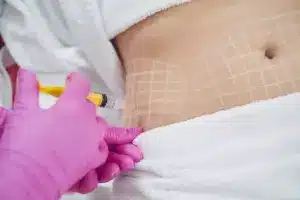 How to Use Kybella Injections for Belly Fat Reduction