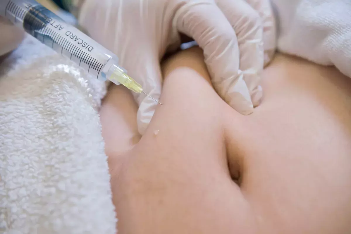 How to Reduce Arm Fat With Dissolving Injections