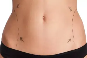 7 Non-Invasive Alternatives to Liposuction for Belly Fat