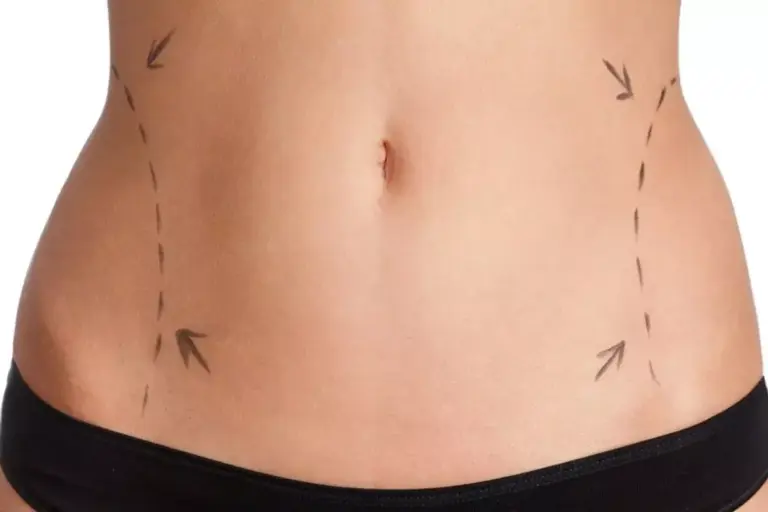 7 Non-Invasive Alternatives to Liposuction for Belly Fat