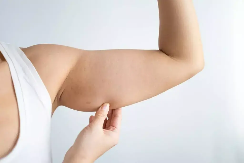 How to Remove Arm Fat With CoolSculpting: Results Explained 3 How to Remove Arm Fat With CoolSculpting: Results Explained