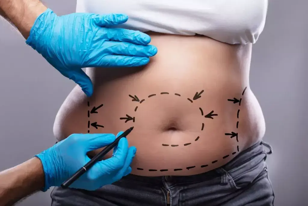 How to Remove Belly Fat: Surgery & Non-Invasive Options 2 How to Remove Belly Fat: Surgery & Non-Invasive Options
