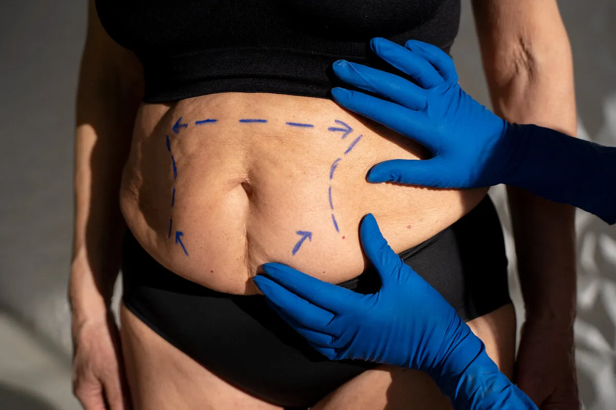What's the Difference Between Liposuction and Tummy Tuck?