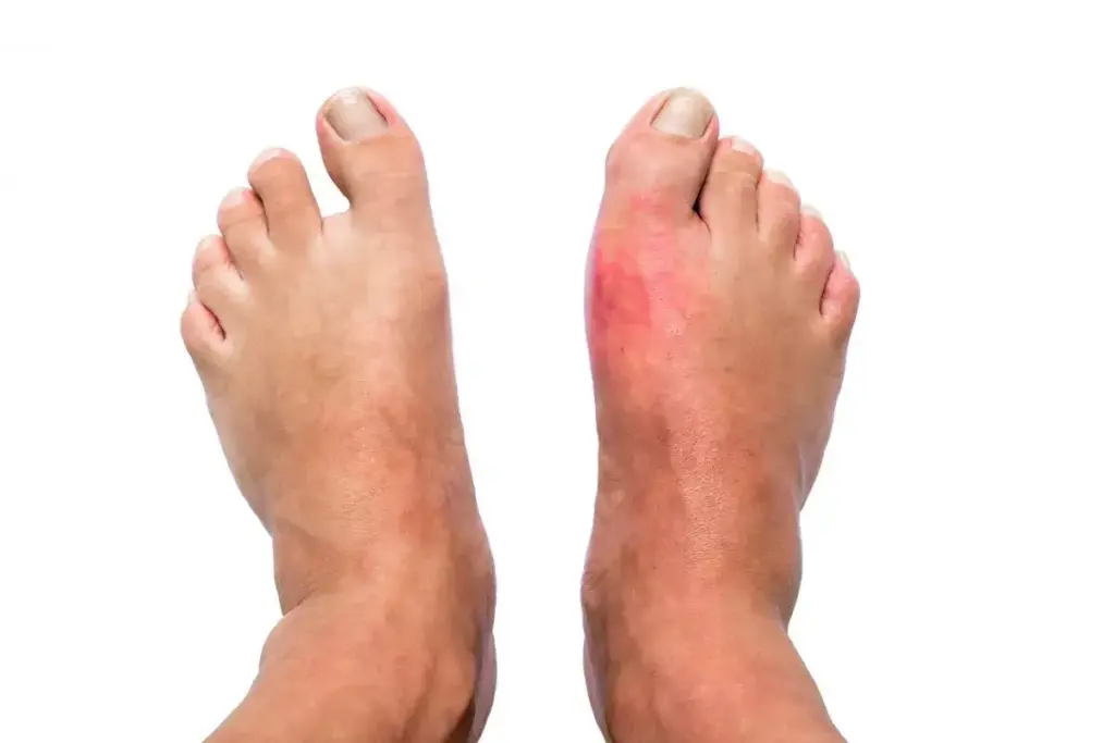 Why Are My Ankles Swollen With High Blood Pressure?