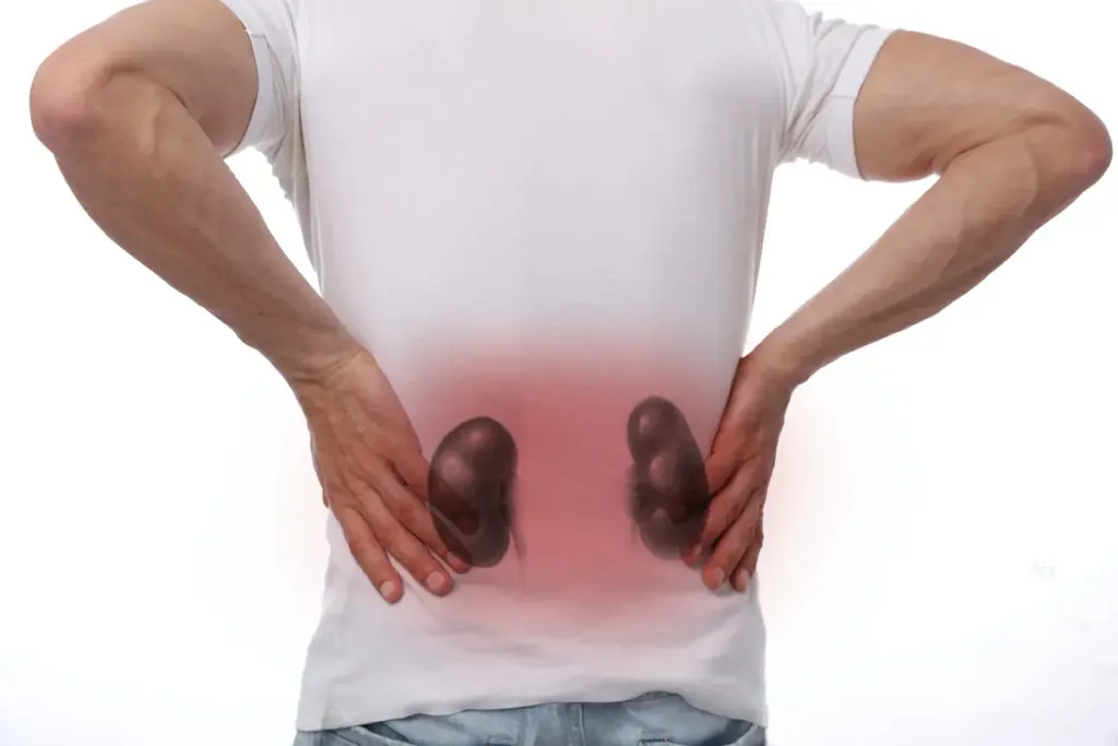 How to Get Rid of Kidney Infection Naturally