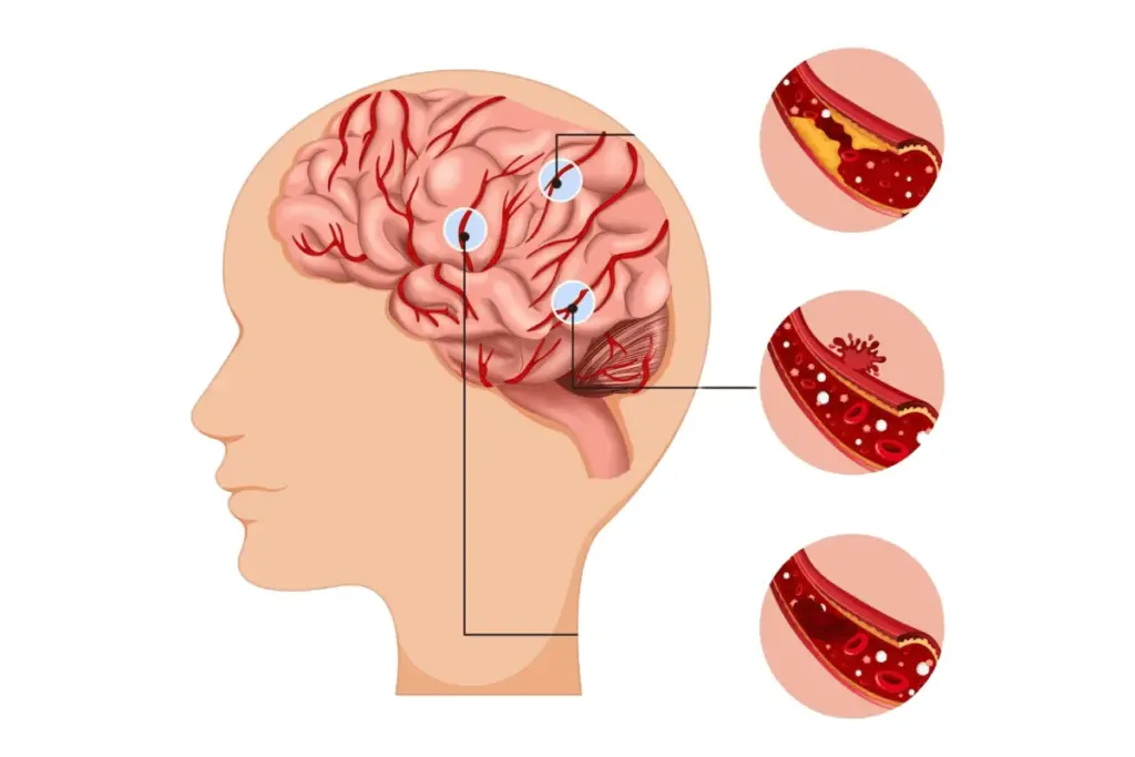 What Is AVF? Understanding Arteriovenous Fistula in the Brain 1 What Is AVF? Understanding Arteriovenous Fistula in the Brain