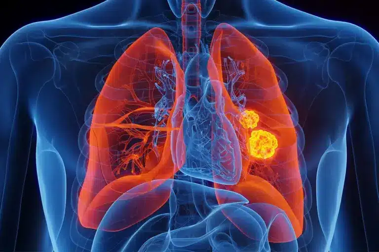 EGFR Testing for Lung Cancer: 5 Key Facts About Mutations and Treatment