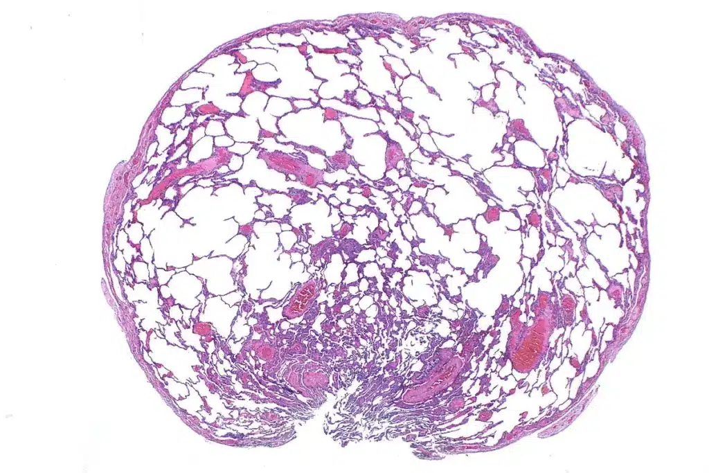 5 Key Differences Between CKD vs AKI: Types, Causes & Pathophysiology