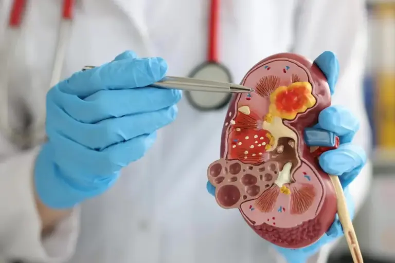 Acute on Chronic Kidney Disease: 5 Key Differences from AKI