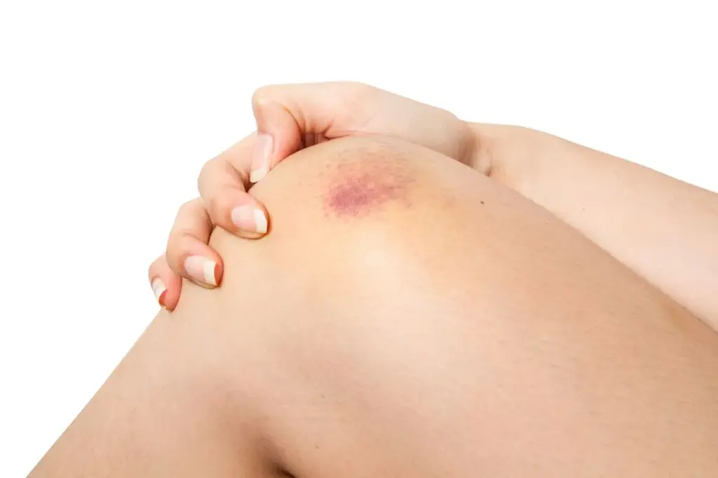 How to Treat Graze Wounds: Stop Bleeding and Pain 1 How to Treat Graze Wounds: Stop Bleeding and Pain