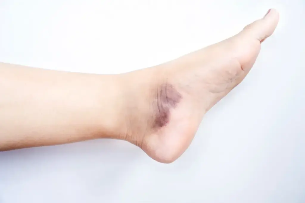 Can Cellulitis Cause Bruising and Red Streaking on Your Skin? 1 Can Cellulitis Cause Bruising and Red Streaking on Your Skin?