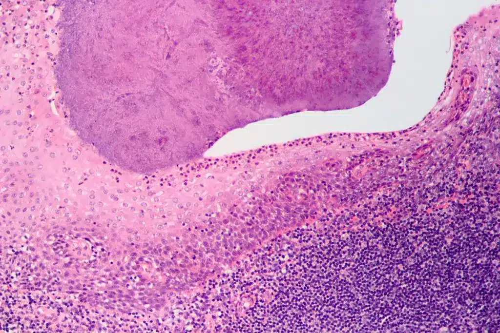 Bacterial vs viral tonsillitis: Easy facts.