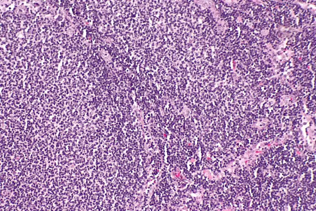 Tonsil lymphoma symptoms: Best easy tips.