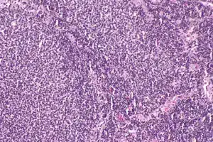 Tonsil lymphoma symptoms: Best easy tips.