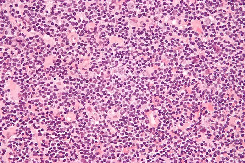 Tonsil lymphoma symptoms: Best easy tips.