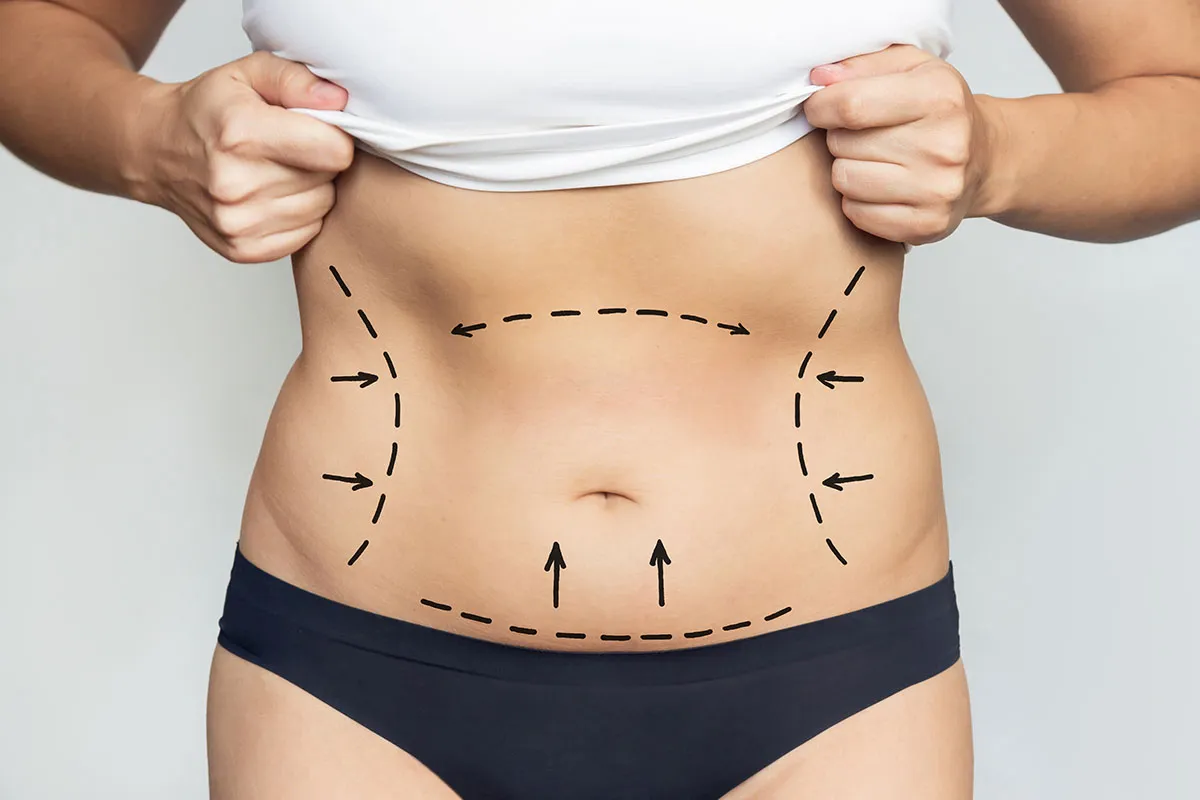 Lipo 360 vs Tummy Tuck: Which Procedure Is Right for You?