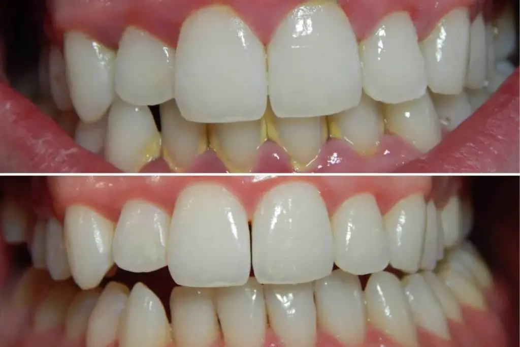 Cystoscopy Procedure Female: What to Expect 2 Cystoscopy Procedure Female: What to Expect