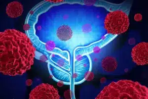 Erection After Prostate Removal: Causes & Solutions