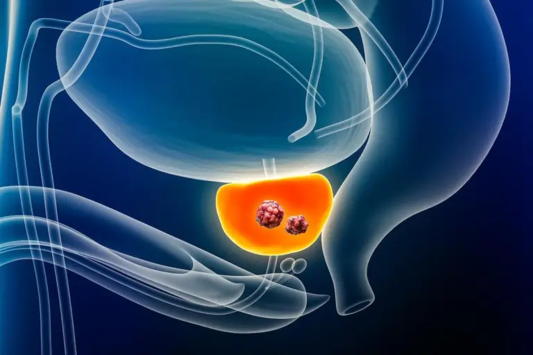 Prostate Cancer: 5 Crucial Warning Signs