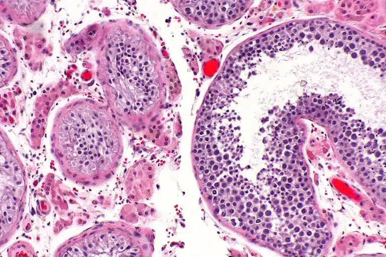 Testicular Cancer Symptoms: Feeling Sick?