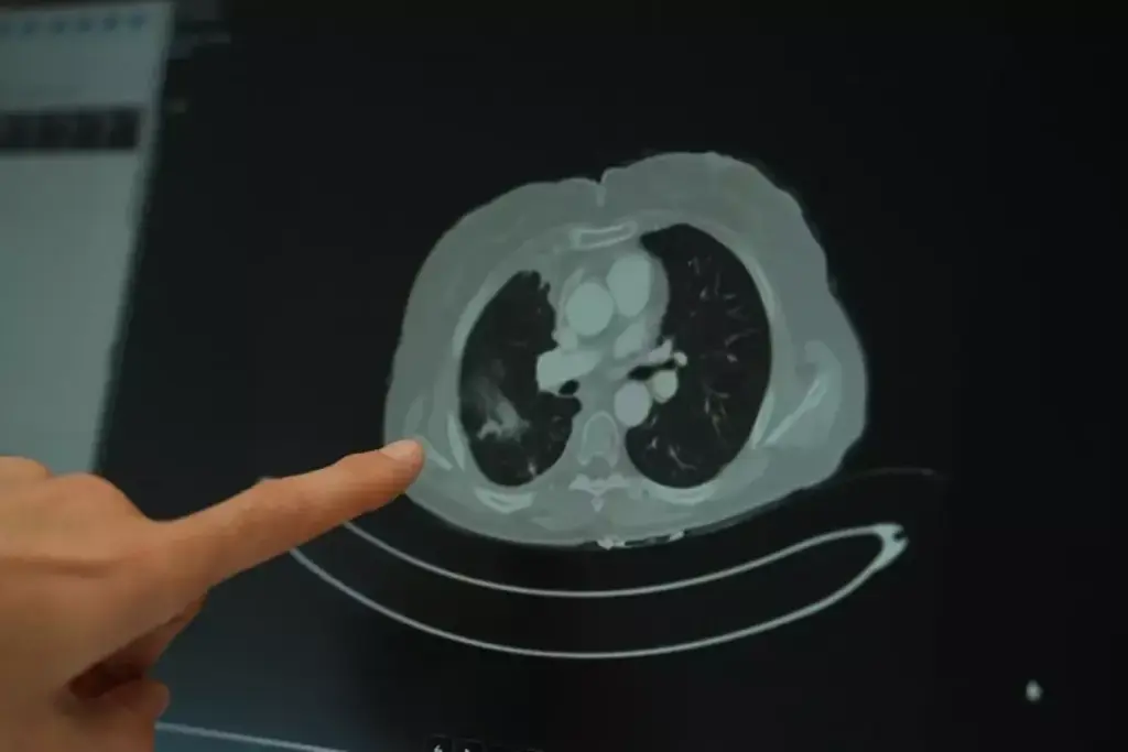 Testicular Cancer Survival Rate: Facts