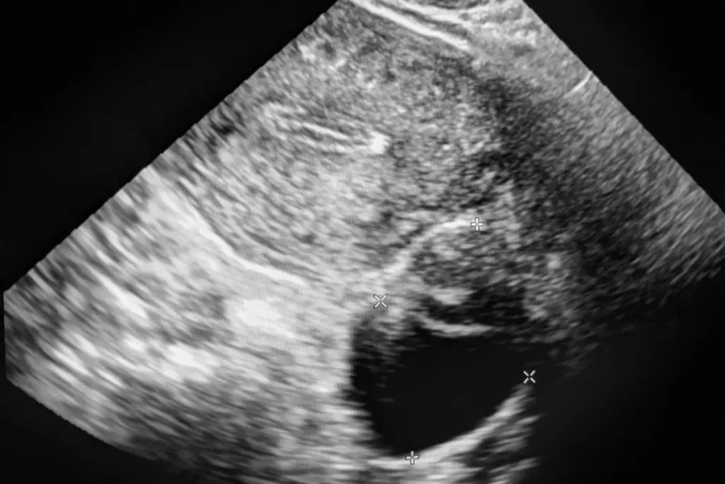 Testicular Cancer: Ultrasound Success