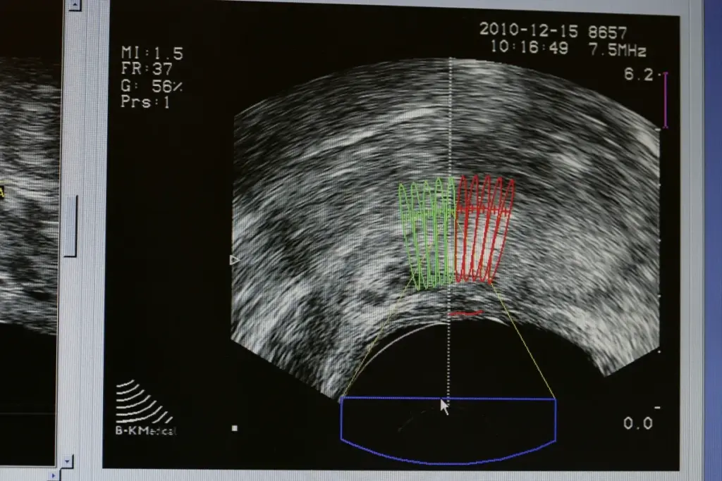 Testicular Cancer: Ultrasound Success