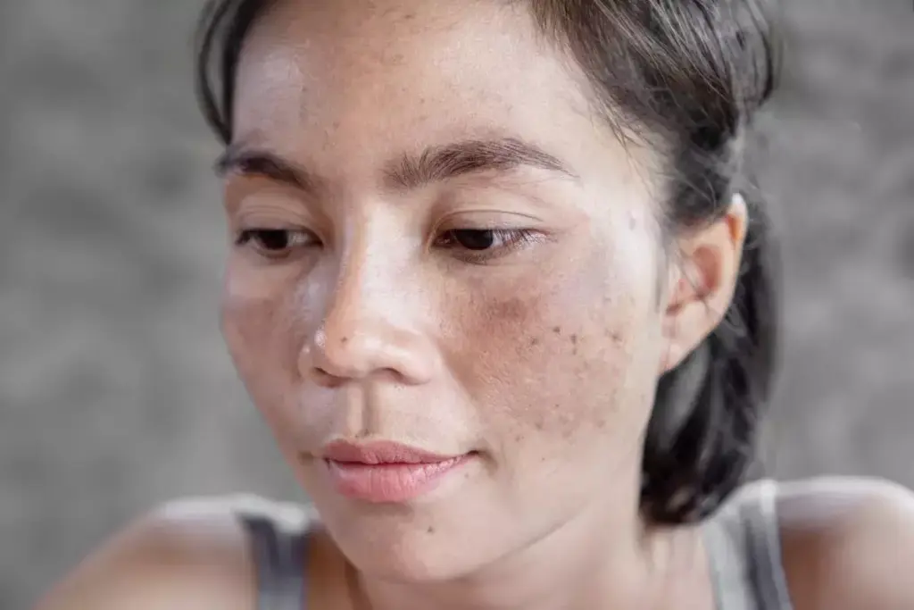 How to Remove Spot Scars: Get Rid of Acne Holes