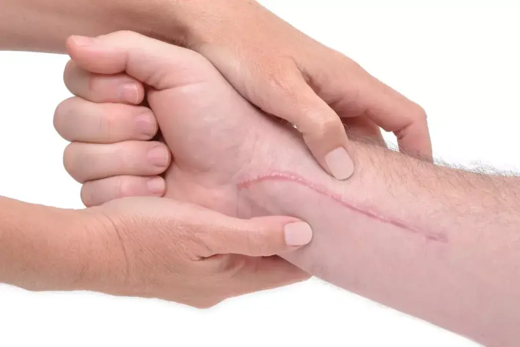 How to Relieve Scar Tissue Pain After Surgery 2 How to Relieve Scar Tissue Pain After Surgery