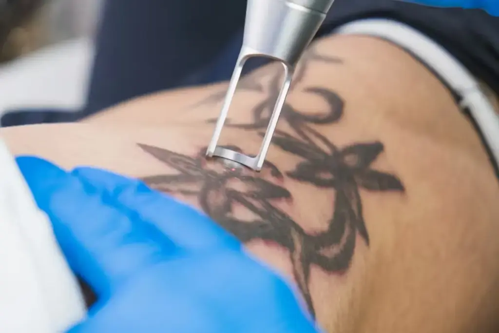 How to Remove a Tattoo: Surgical Excision vs Chemical Peel
